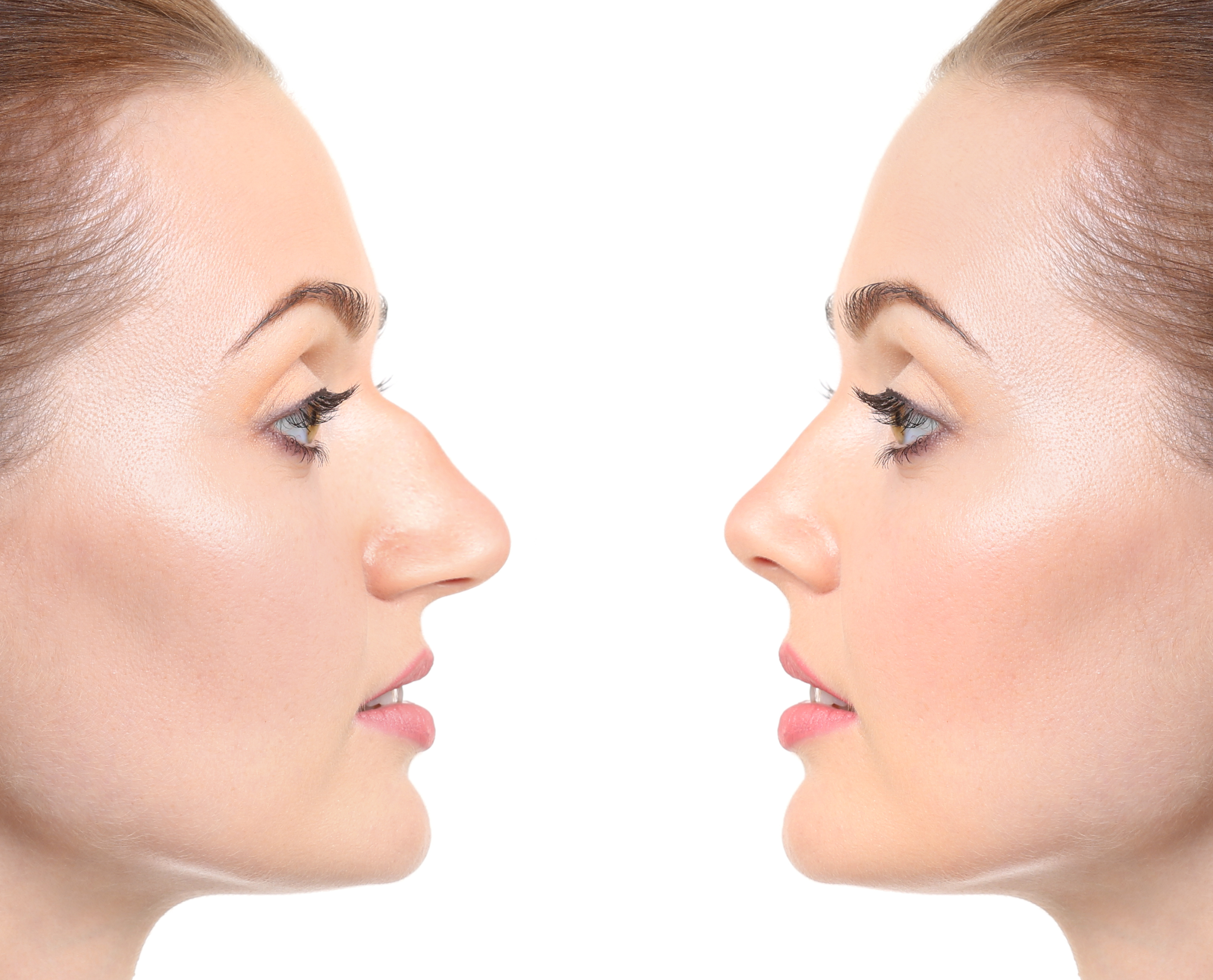 The Complete Guide to Revision Rhinoplasty